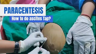 Paracentesis Procedure Ascites Tap in detail [upl. by Bowne]