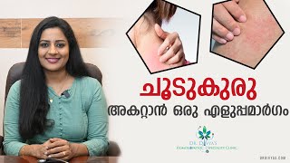 ചൂടുകുരു അകറ്റാൻ ഒരു എളുപ്പമാർഗം How To Treat amp Prevent Heat Rash  Summer Skin Rashes Home Remedy [upl. by Fennell]