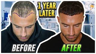 My Hair Transplant Results After 1 Year [upl. by Petit]