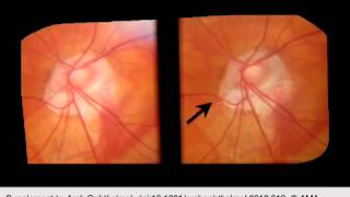 Detection of Progressive Glaucomatous Optic Neuropathy Using Automated Alternation Flicker With Ster [upl. by Ellenej]