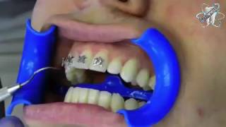 Watch how dentist put your braces on [upl. by Vedis223]