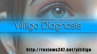 Vitiligo Diagnosis Age [upl. by Noslrac]