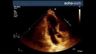 EchoWeb  Left Ventricular Akinesis [upl. by Adnoek]