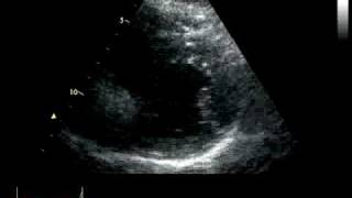 ACUTE CORONARY SYNDROME  HYPOKINESIA [upl. by Osana]