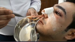 Removing nose mesh 2 days after rhinoplasty surgery  خارج کردن مش بینی 2 روز بعد از عمل جراحی [upl. by Esinned198]