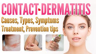 irritant contact dermatitis [upl. by Reniti646]