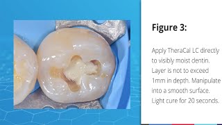 Indirect Pulp Capping Case using TheraCal LC [upl. by Llednyl]