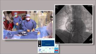 Part 5B of 6 Cryoballoon ablation for Atrial Fibrillation by Wilber Su [upl. by Cirdla884]