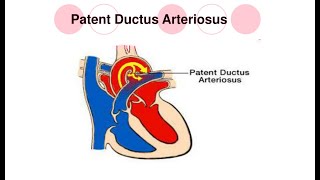 PDA  Congenital heart defect 4  with mnemonics [upl. by Eillor472]