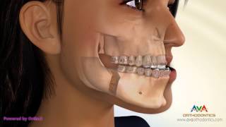 Surgical Orthodontic Treatment for Underbite or Crossbite  BSSO Mandibular Setback [upl. by Yleve]