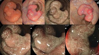 ESD of 4cm sigmoid lesion Water pressure amp Magnification JCEM 30 [upl. by Alegnasor875]