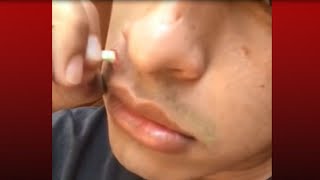 What Popped Out of My Face Cysts Pimples Abscesses Whiteheads and Zits [upl. by Slinkman]