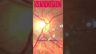 Myopic Fundus  Fundus Photography  Myopic Crescent  Short Video 158 viral optometryacademy [upl. by Irpac]