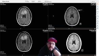 Hirntumor WHO Grade 4 Eine Zweite Biopsie steht bevor [upl. by Ania554]