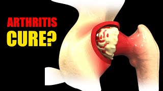 Arthritis Youre Treating It Wrong See How to Actually Repair Cartilage [upl. by Enyala]