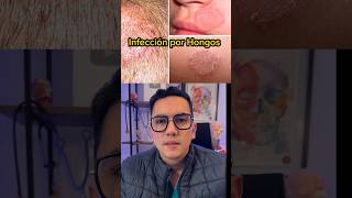 Infecciones por hongos en la piel  Dr William Guerrero medicina shorts [upl. by Haron]