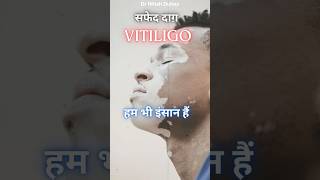 vitiligo awareness shorts vitiligo skincare [upl. by Reiser]