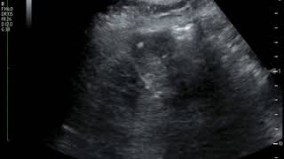 Subcapsular Hematoma Ultrasound JETem 2018 [upl. by Goober476]