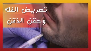 MEN CHIN AUGMENTATION  DrMaen Alkhateeb تكساس للرجال تعريض الفك و حقن الذقن بالفيلر د معن الخطيب [upl. by Malet]