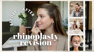 My Rhinoplasty Revision Experience Before  After Recovery Cost  Hospital Stay [upl. by Anitac]