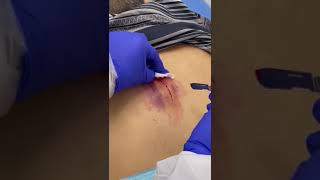 Back Sebaceous Cyst Removal [upl. by Kung]