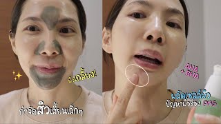 SKIN  Skincare ผลัดเซลล์ผิว แก้ปัญหาผิว สิวฮอร์โมน รูขุมขนกว้าง ช่วงมีอาการ PMS และมีประจำเดือน [upl. by Livvi817]