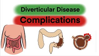 Complications of Diverticular Disease [upl. by Adlemy]