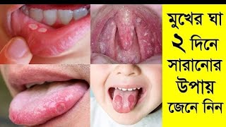 Micosina Oral Gel  Miconazole  মুখের ঘা দূর করার সেরাজেল [upl. by Notsgnal436]