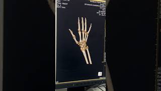 Ct Scan Wrist 3D 🫰 [upl. by Anair]