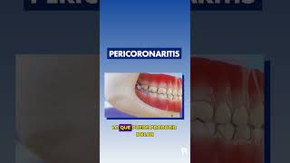 PERICORONARITIS e INFECCIÓN de MUELAS del JUICIO  Muelas IMPACTADAS [upl. by Sakhuja973]