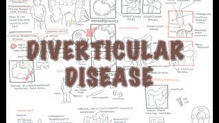 Diverticular Disease diverticulitis  Overview [upl. by Dasha]