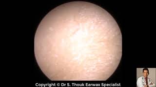 Top Biggest Ear Wax Removal 121  Ear wax Extraction  Dr S Thouk Earwax Specialist [upl. by Howund561]