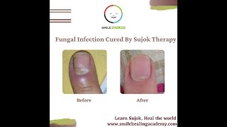 Fungal Infection of Nail Cured By Sujok Therapy [upl. by Llenyaj]