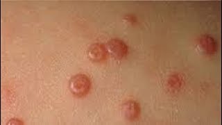 how to get rid of molluscum contagiosum at home [upl. by Aerised]