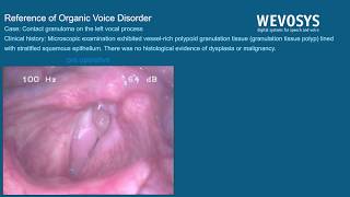 Contact granuloma on the left vocal process [upl. by Phail]