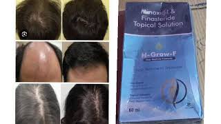 H Grow F Topical Solution Minoxidil amp Finasteride Topical Solution [upl. by Bluh]