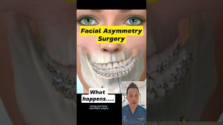 Facial Asymmetry Surgery What to Expect dentallan shorts dentist [upl. by Adley]