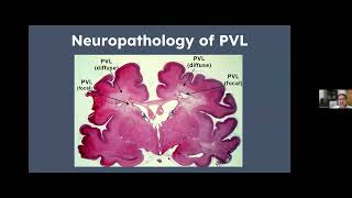 NSGR Vulnerability of the Preterm Brain amp Periventricular Leukomalacia Dr Michael Kruer 81224 [upl. by Gardie]