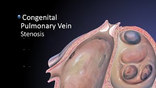 Pulmonay Vein stenosis Rare case [upl. by Isabel470]