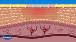 Dermalex Rosacea  How it works [upl. by Atiuqram]