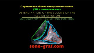УЗИ  Определение объема плеврального выпота [upl. by Leander90]