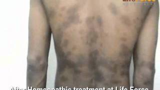 Psoriasis Vulgaris Spots on Face Forehead Chest Arms amp Back Treatment at Life Force [upl. by Iroj]