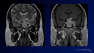 Neuroradiology Board Review  Brain Tumors  Case 5 [upl. by Eben185]