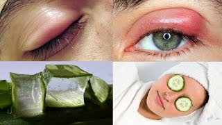 Effective Natural Home Remedies for Swollen Eyes  Home remedies Puffy eyes [upl. by Mella]