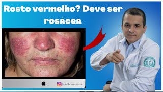 MILIUM PÚSTULAS E SIRINGOMA no Rosto  Identifique as alterações da pele quotbolinhas brancasquot [upl. by Eldrid820]