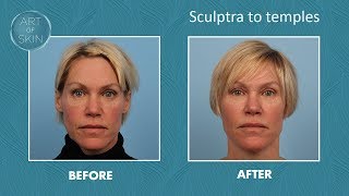 Sculptra injection to temples [upl. by Eelano]