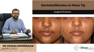 Dermatofibroma on nose  Surgical excision  Dr Yogesh Bhingradia [upl. by Enylcaj139]