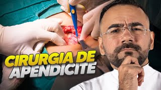 COMO É FEITO A CIRURGIA DE APENDICITE APENDICECTOMIA [upl. by Nnaylime149]