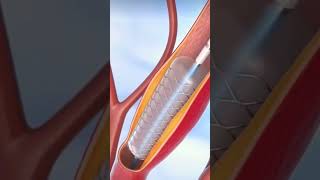 Angioplasty procedure animation shortsheartattackcardiac surgerystentbypass [upl. by Ohce]