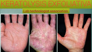 Everything you know about keratolysis exfoliativa [upl. by Edasalof]